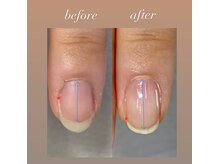 爪が小さいとお悩みでも本来持つ自爪へと育てていきます。