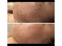 ソラ 菊陽光の森(SOLA+)/ニキビケア