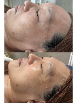 ヨルエステ(yoru aesthe)/【シミケア】