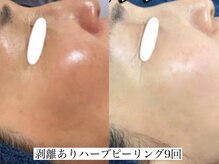 アリス(ALICE)/TIPの効果