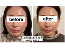 グリーン鍼灸整体院(green鍼灸整体院)/美容鍼（ビフォーアフター）