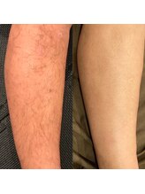 ボウソウ(BOSO)/LED脱毛（2）