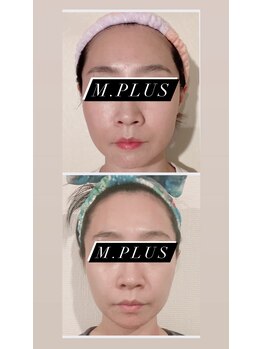 エムプリュ 心斎橋店(M.plus)/フェイシャル★★★