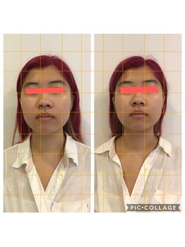 ビュースタイル川西/すっきり小顔矯正