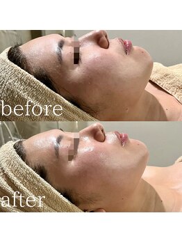 サロン ド ブラン アオヤマ(Salon de BLANC AOYAMA)/BLANC式小顔ソノケアコース90分