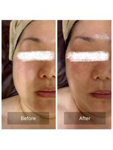 ラビ(RABBI)/50代女性　小顔矯正EMS＋RF 