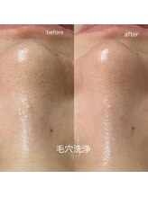 パールフェイスエステ ルペルル(PEARL FACE ESTHE la perle)/毛穴のお悩み改善