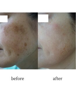 アップルミント/＜フェイシャル＞before・after