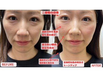 フラット柏(FLAT柏)/【毛穴】30代美容鍼befor&after