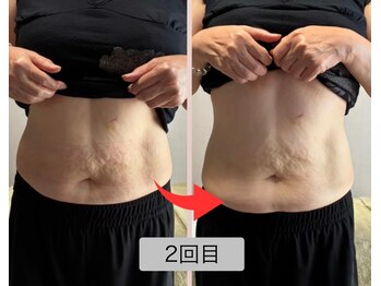 リセル(Recell)/お腹★脂肪分解