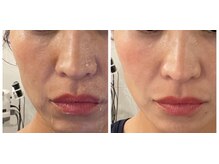 【エステ】毛穴引き締め&シワたるみ改善最新小顔リフトHIRF.WAVE