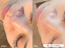 フォンビューティー(fon beauty)/毛穴ケア1回