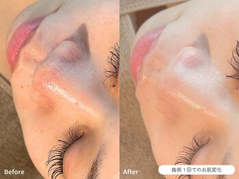 フォンビューティー(fon beauty)/毛穴ケア1回