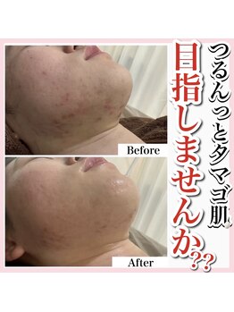 ホワイトアクア 天王寺本店(WHITE AQUA)/ハーブピーリング/大阪/天王寺