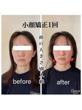 リバイブ 五反田店(REVIVE)/小顔矯正1回《中顔面短縮》