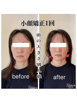 リバイブ 五反田店(REVIVE)/小顔矯正1回《中顔面短縮》