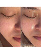 ミニョンプラス(Mignon+)/シワたわみ肌荒れくすみ解消