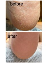 マルソ(marco)/足裏ケア