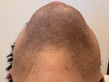 オアシスラグーン(OASIS LAGOON)/メンズ脱毛（症例２：before）