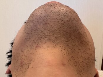 オアシスラグーン(OASIS LAGOON)/メンズ脱毛(症例2:before)