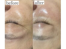 アンドエスビューティ(&S Beauty)/乳酸ピーリング+プラズマ