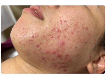 スキンケアスタジオ アコ 新宿店(Aco)/GP5daysニキビでお悩みのお客様
