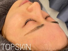 トップスキン 栄(TOPSKIN)/ハーブピーリングTCLINE施術直後