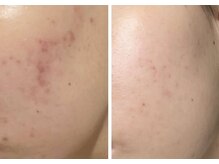 エターナル(Eternal)/ララピールで肌悩み解決！