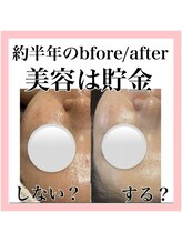 エクラーレ(Eclale)/ハーブピーリング症例