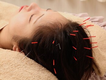 ノア鍼灸院 温灸堂(NOA鍼灸院)/ヘッドスパ/頭皮鍼