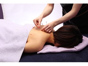 シー バイ カリスタ 表参道店(C by CALISTA)/背中の鍼で肩こりもすっきり