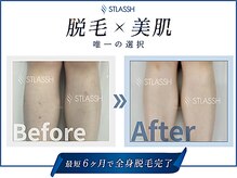 ストラッシュ 大宮店(STLASSH)/メニュー：全身脱毛（足）