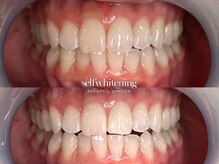 ココロビューティーギャラリー 武蔵小杉(cocorobeauty gallery)/セルフホワイトニング