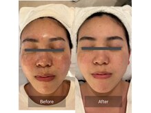 肌の奥まで届ける特殊ハーブピーリングでシミニキビ毛穴肌改善！