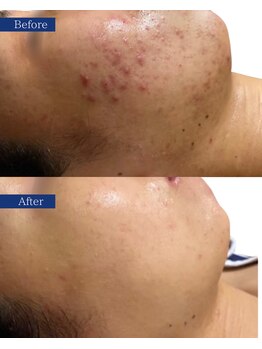 ビズビズ(bisebise)/メンズニキビ学割U24★大阪梅田