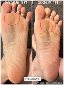 リレフー(Relafy)/足の魚の目！