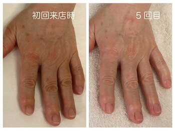キレイテ 上野店/60代/5回目【ハンドケア上野】
