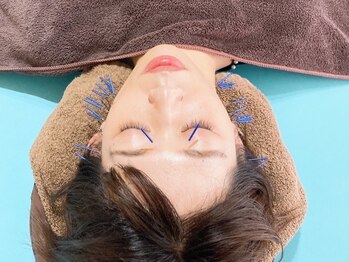 ロハリ(Lohari)の写真/<美容鍼トライアル/初回¥4500>歴10年の技術力で根本からたるみケア！肌トラブル・ニキビケア、ハリ艶感UP◎