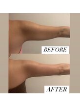 フェミニー(Feminy)/夏に向けて二の腕！！痩身！