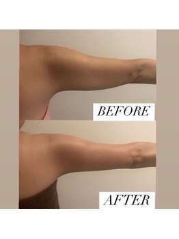 フェミニー(Feminy)/夏に向けて二の腕！！痩身！