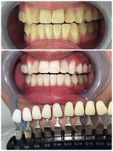 エクシア ホワイトニング 富山店/ビフォーアフター写真☆