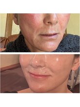 アマラ(Amarra)/プラズマ×限界濃度IPSで若見え