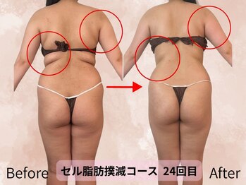 ハナ チュチュ(Hana chuchu)/セル脂肪撲滅コース 24回目