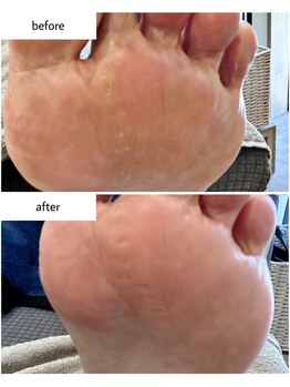 ケアプラス(care plus)/ウオノメケア