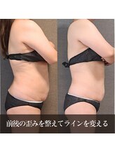 バンブー(bamboo)/反り腰・猫背・ぽっこりお腹