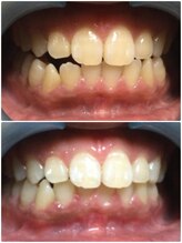 カルム(Calme)/セルフホワイトニング