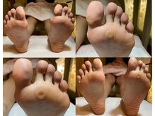 ビサンテ サロン/足の魚の目,たこは高プロケアに