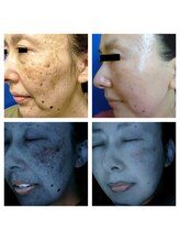 グリッター(GLITTER)/肌質分析診断★