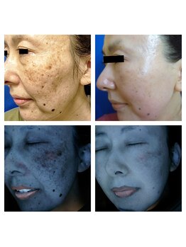 グリッター(GLITTER)/肌質分析診断★