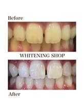 ホワイトニングショップ 池田店/【BEFORE/AFTER】